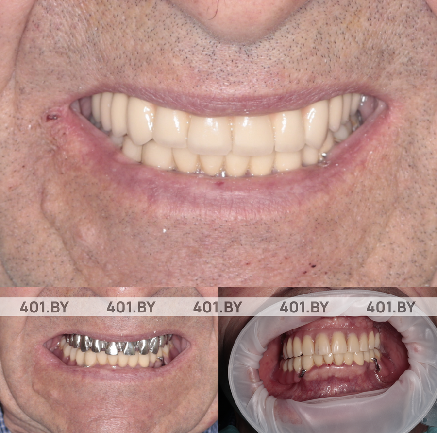 Комплексное протезирование методом All-on-4 с применением циркониевой постоянной конструкции. До